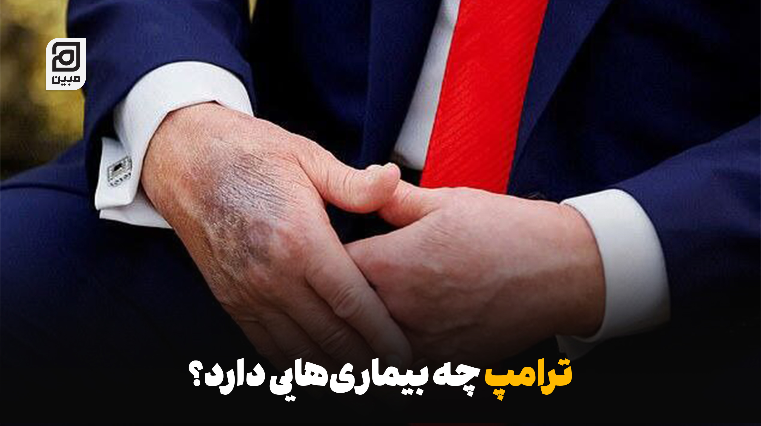 ترامپ چه بیماری‌هایی دارد؟